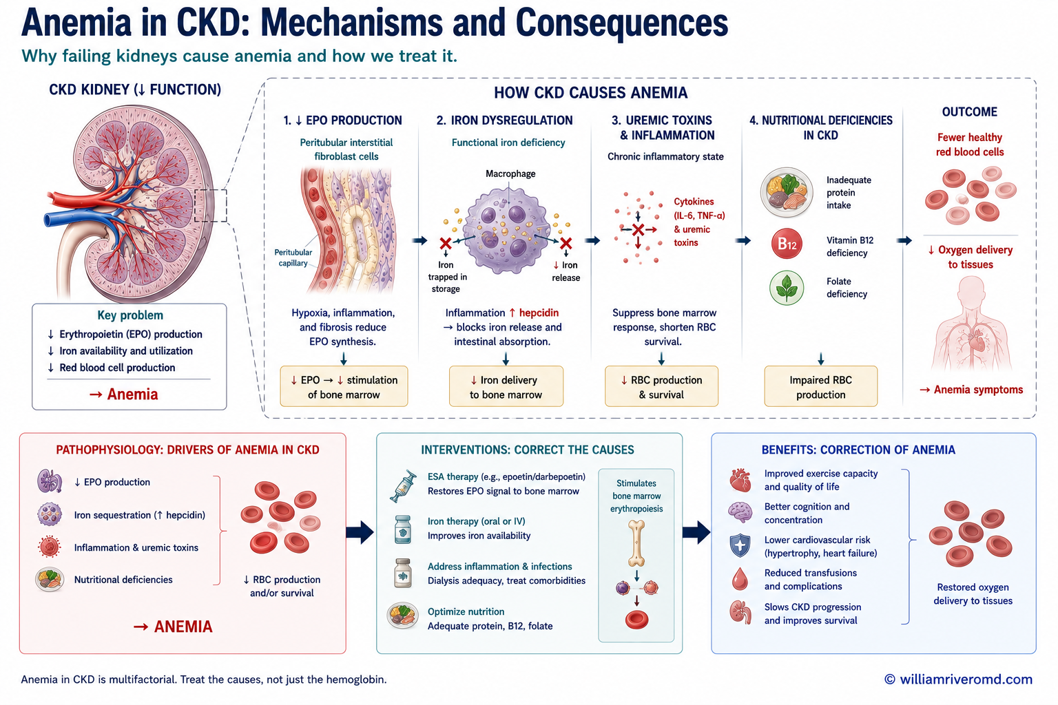 Why CKD causes anemia — four mechanisms: EPO deficiency, hepcidin-mediated iron restriction, uremic toxin-shortened RBC lifespan, and PTH-driven marrow fibrosis