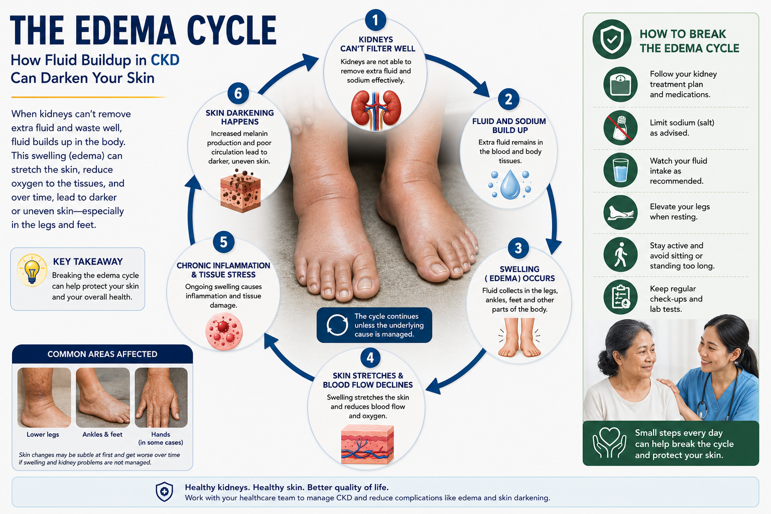 The edema-dialysis cycle and ET-1–driven melanogenesis in lower-leg skin — diagram by W Rivero, MD