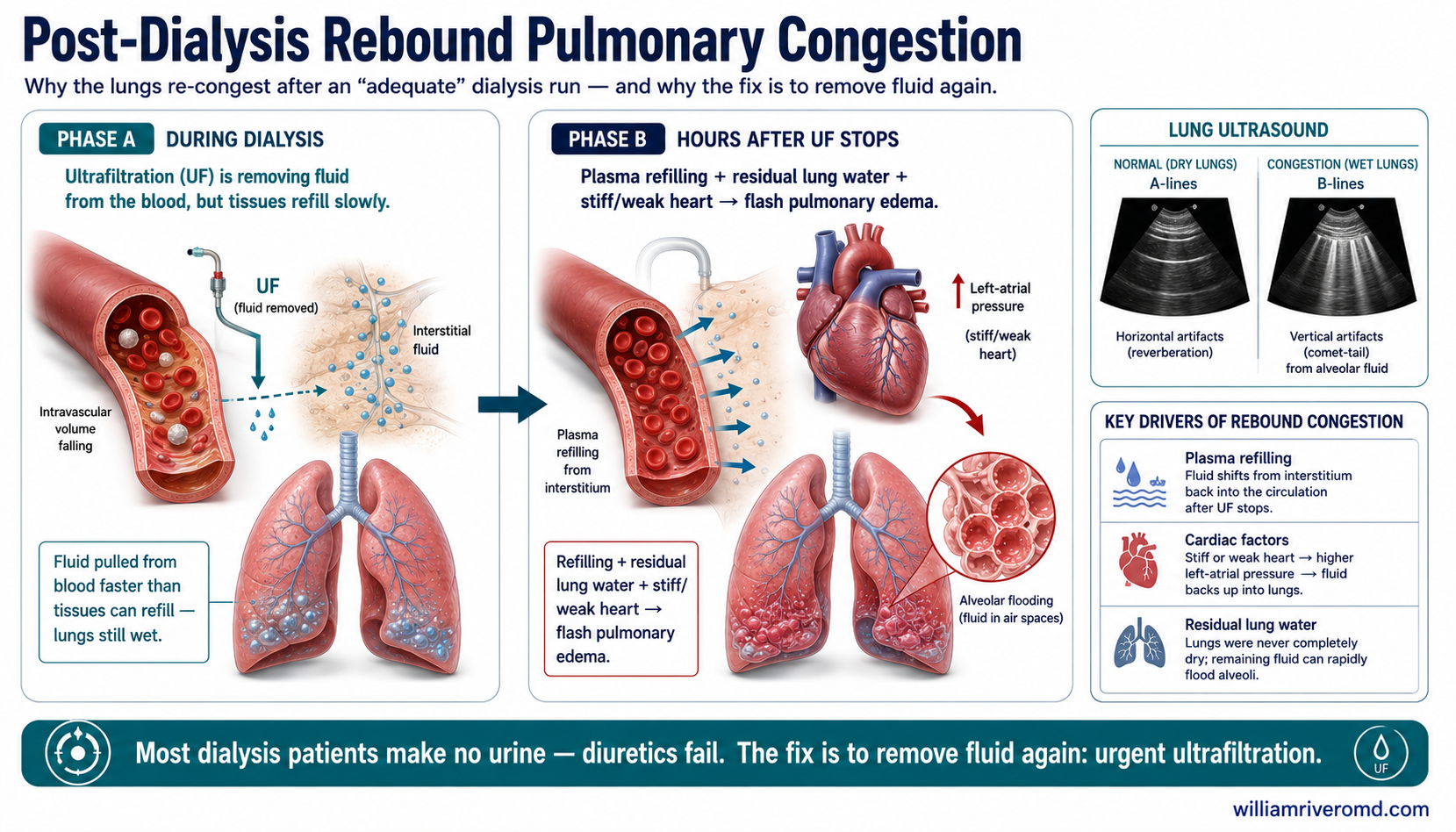 Post-dialysis rebound pulmonary congestion mechanism — during ultrafiltration fluid is pulled from the blood faster than tissues refill; after UF stops, plasma refilling plus residual lung water and a stiff heart flood the alveoli; lung ultrasound shows B-lines; the fix is urgent ultrafiltration, not diuretics