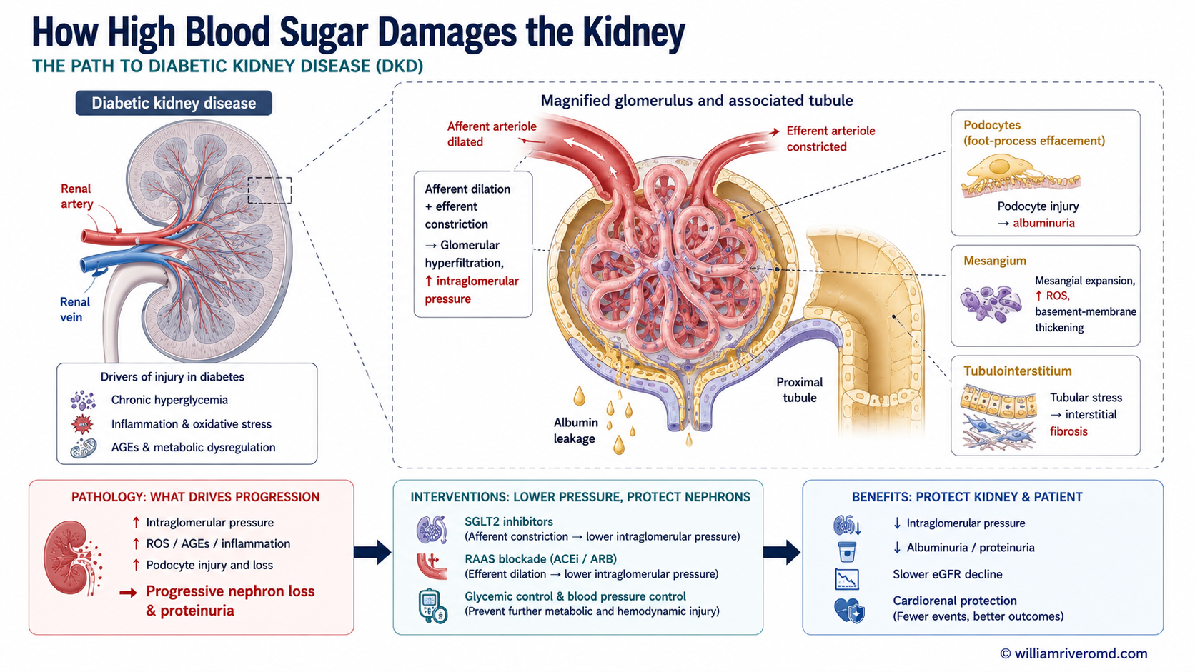 Biomedical mechanism schematic of diabetic kidney disease: chronic high blood sugar causes glomerular hyperfiltration and podocyte injury leading to albuminuria and nephron loss, with SGLT2 inhibitors and RAAS blockade lowering intraglomerular pressure
