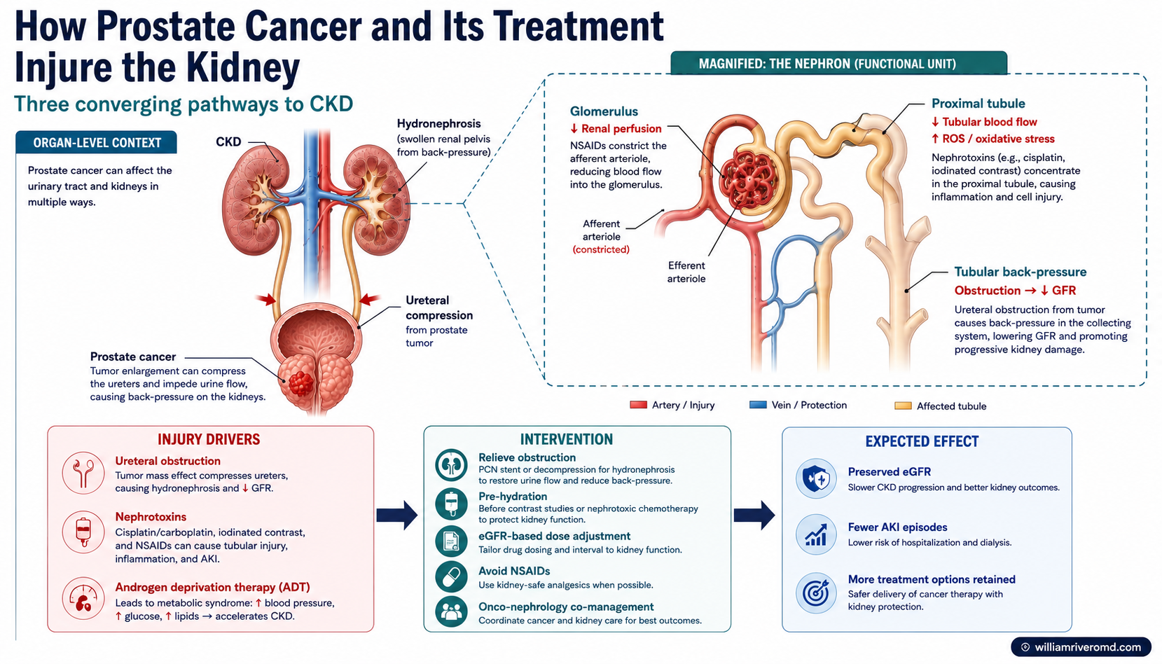 Mechanism schematic showing how prostate cancer compresses the ureters and how nephrotoxic drugs, contrast, NSAIDs, and ADT injure the kidney