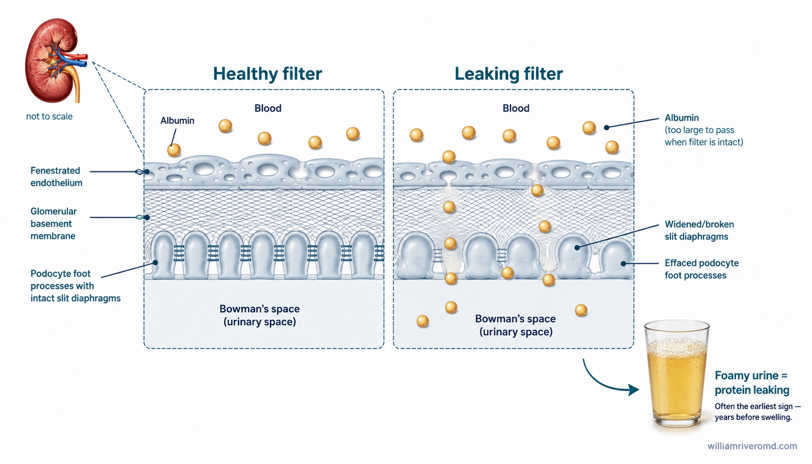 Two side-by-side glomerular filter cross-sections — a healthy filter retaining albumin on the left, and a damaged filter with effaced podocyte foot processes leaking albumin into Bowman's space on the right, with a foamy-urine inset