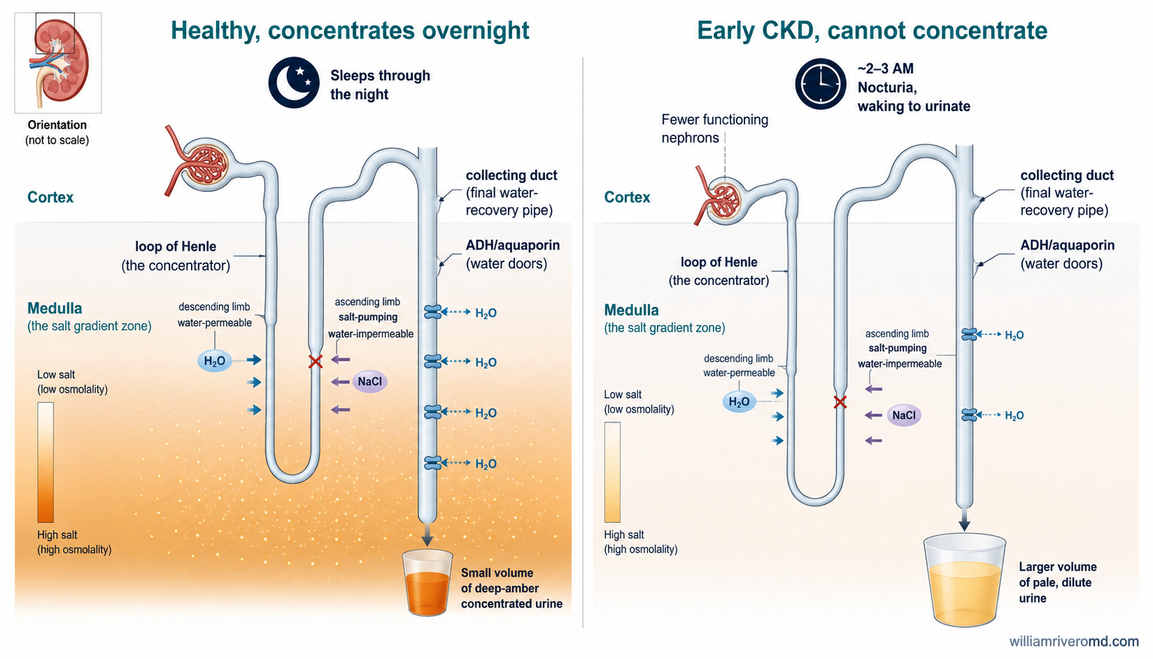 A standalone enlarged nephron diagram comparing a healthy kidney's strong overnight urine-concentrating gradient to an early CKD kidney's blunted gradient, producing larger volumes of pale urine at night